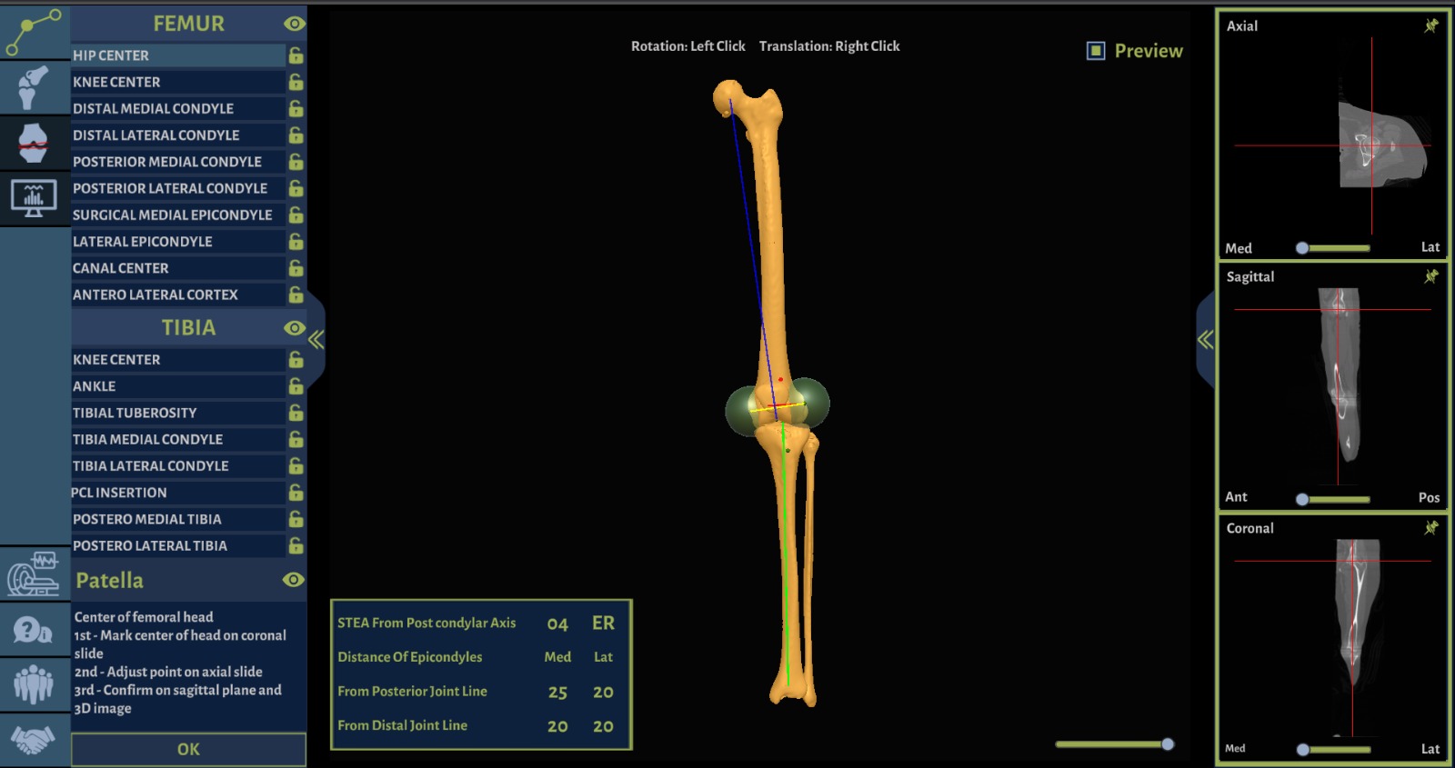 3D Bone Modeling